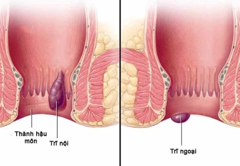 Bệnh trĩ có gây ung thư không?